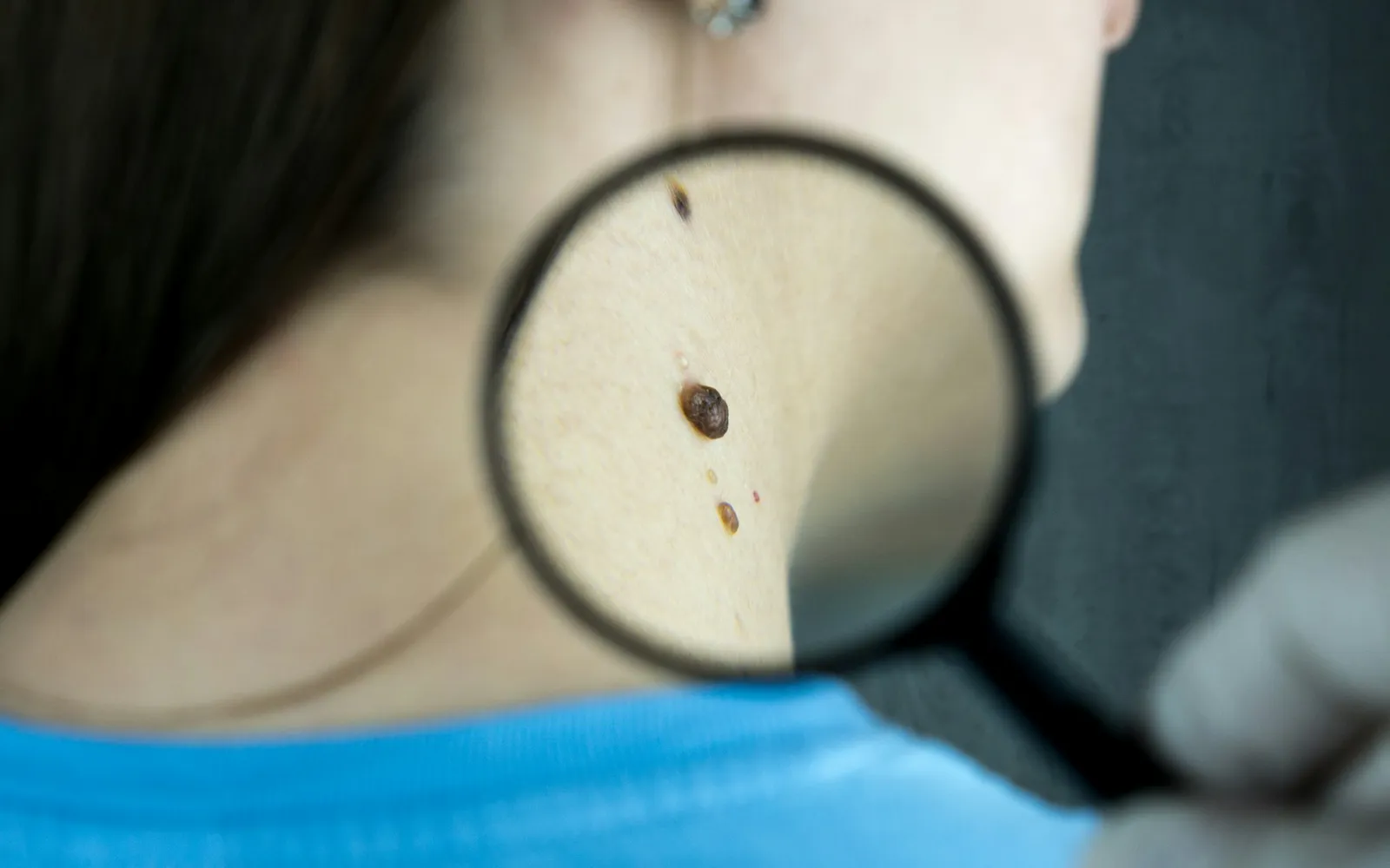 Exérèses et biopsies : des gestes courts, mais invasifs, qui exigent une traçabilité complète.